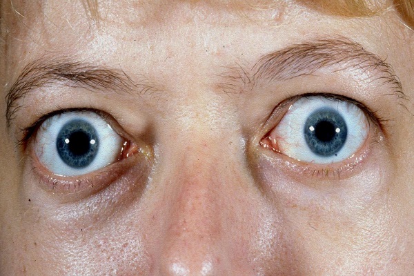 بیماری تیروئید چشمی چیست و چه علائمی دارد؟