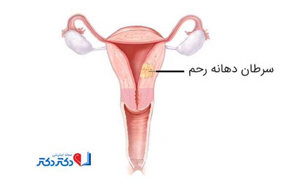 محل تشکیل توده سرطان رحم