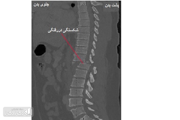 یک عکس سیتیاسکن از شکستگی در رفتگی در مهرههای قفسه سینهای