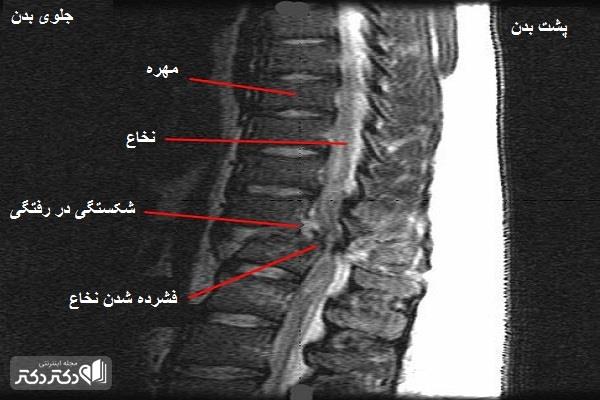الگوهای شکستگی ستون فقرات