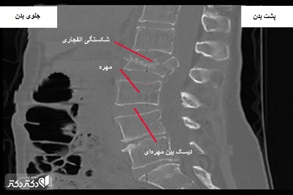 یک عکس سیتیاسکن از شکستگی انفجاری در ناحیه کمری