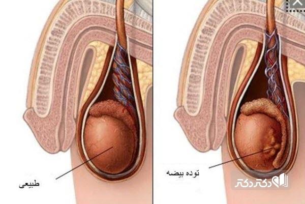 دلایل ابتلا به سرطان بیضه