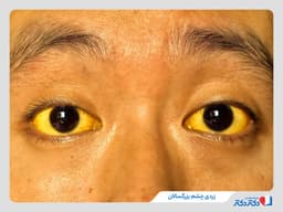 زردی چشم چیست و چرا در کودکان و بزرگسالان ایجاد می‌شود؟