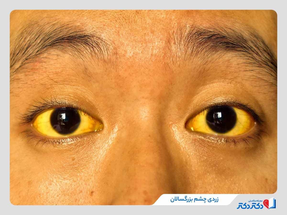 زردی چشم چیست و چرا در کودکان و بزرگسالان ایجاد می‌شود؟