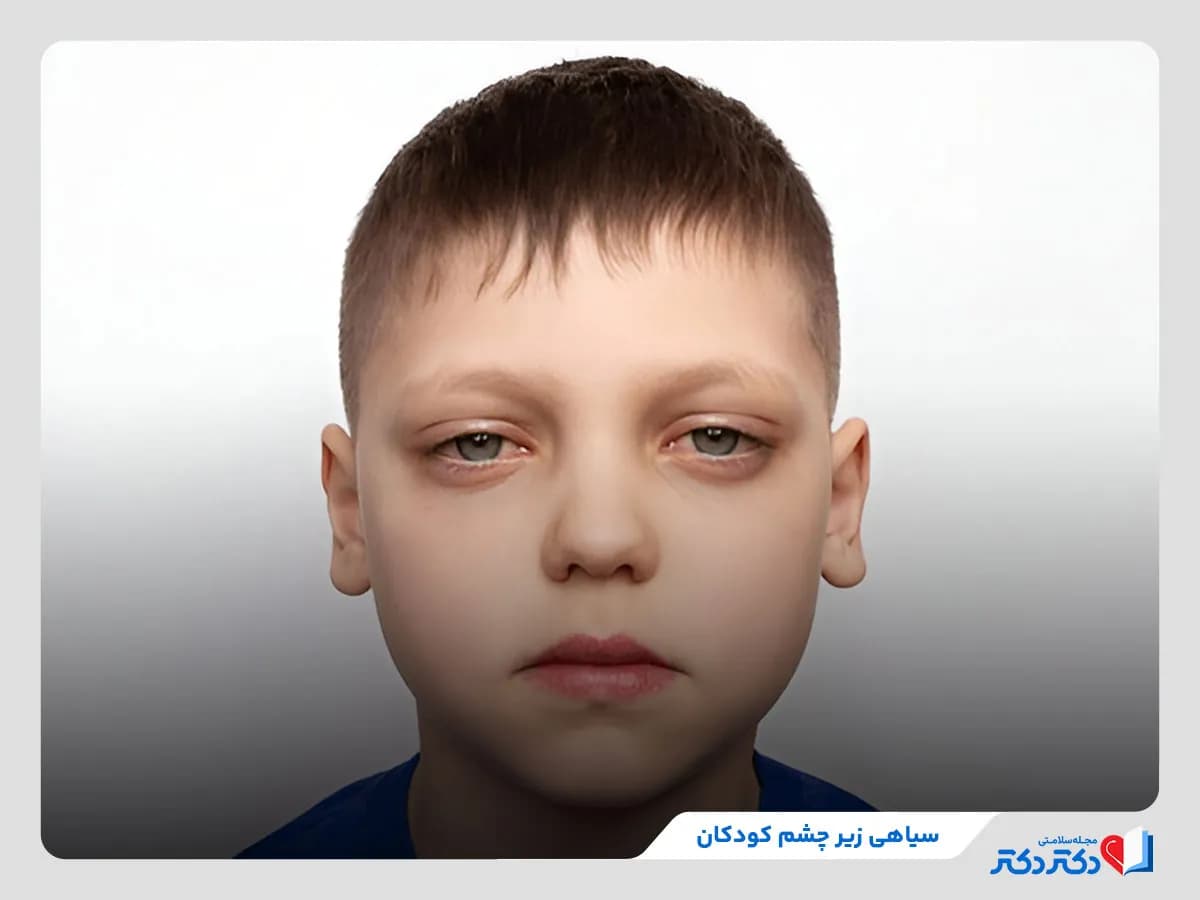 آیا سیاهی زیر چشم کودکان خطرناک است؟ بررسی دلایل و روش‌های درمانی