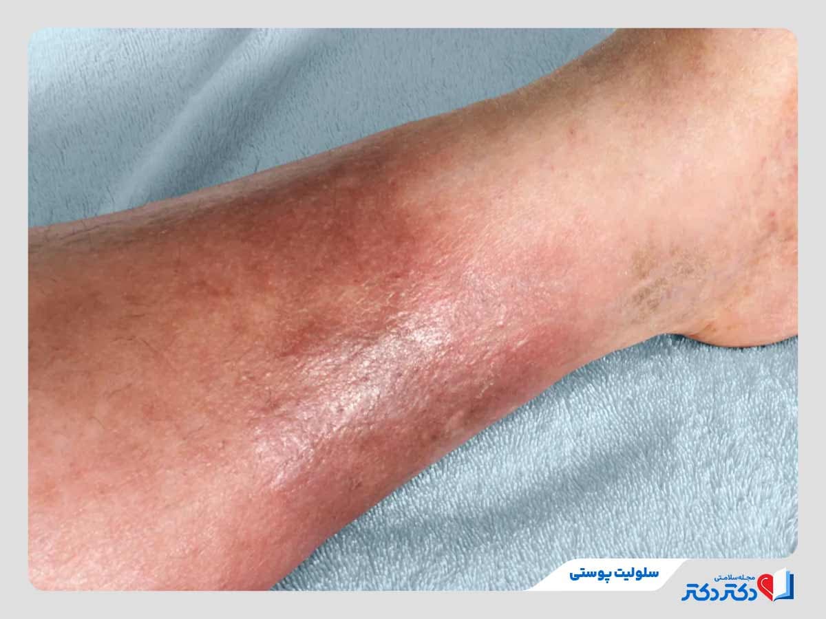 سلولیت پوستی چیست و چگونه ایجاد می‌شود؟