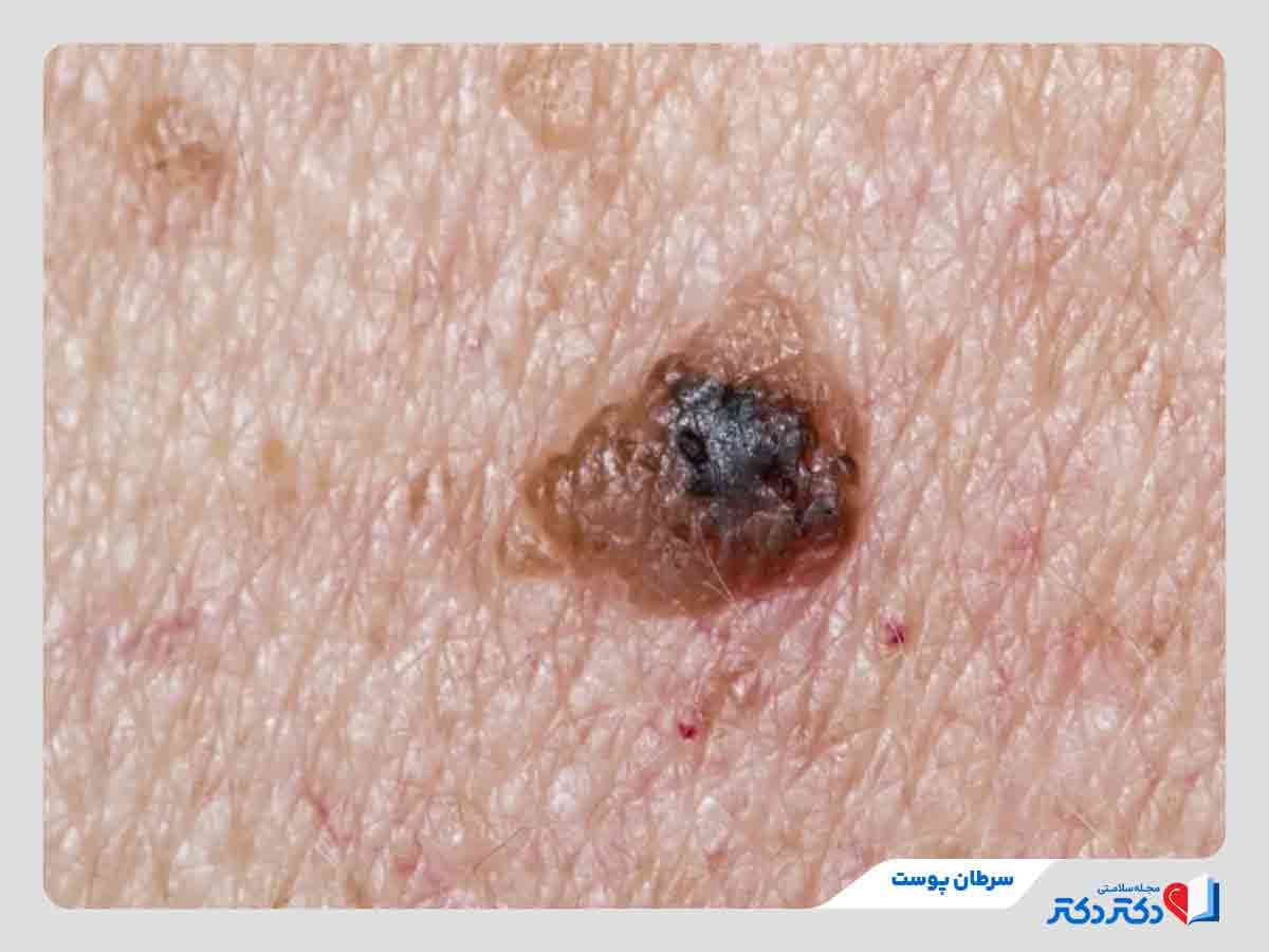 سرطان پوست چیست؟ شناخت کامل علل، علائم و روش‌های درمان