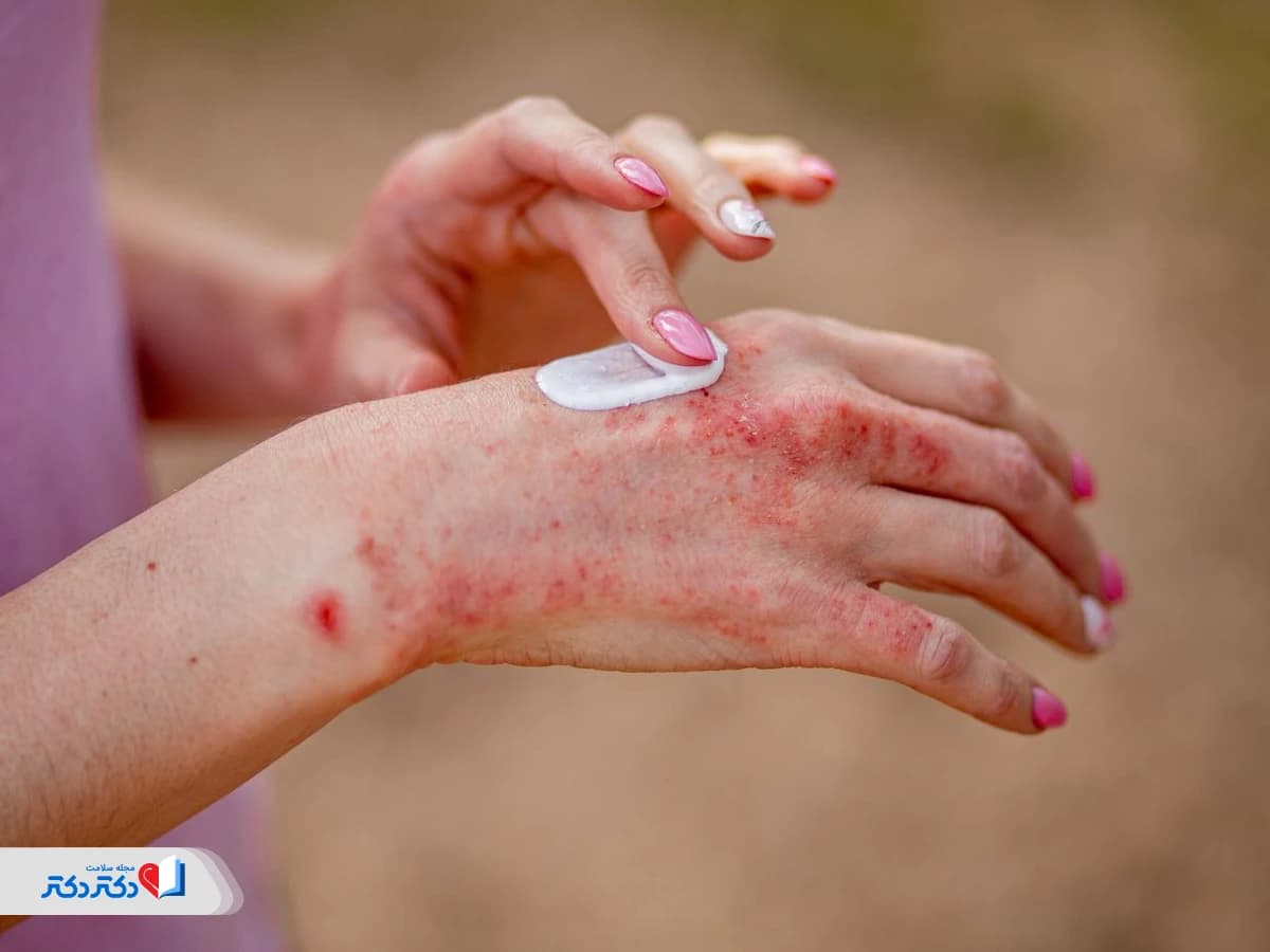 پمادهای موثر برای اگزمای پوستی: راهنمای انتخاب و قیمت