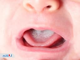 برفک دهان نوزاد چیست؟ علت، علائم و راه های درمانی
