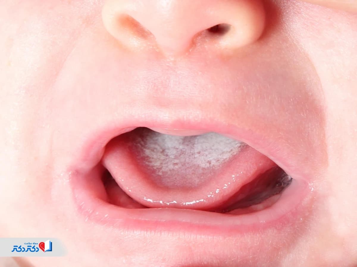 برفک دهان نوزاد چیست؟ علت، علائم و راه های درمانی