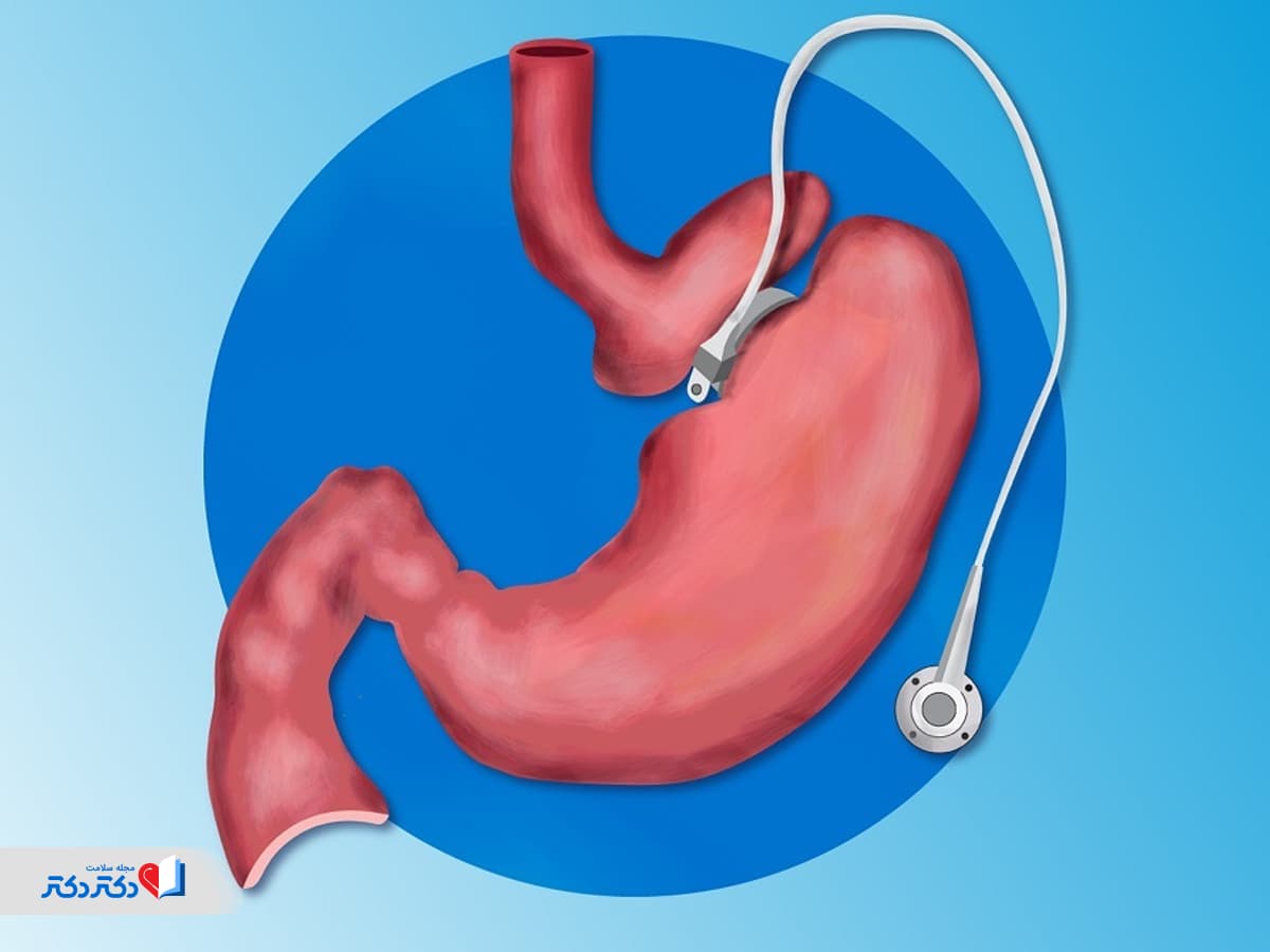 حلقه معده چیست؟ آشنایی با مزایا، عوارض و هزینه‌های آن