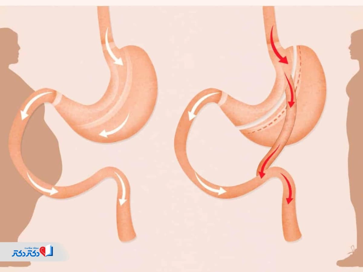 عمل بای پس معده: همه چیز درباره عمل، فواید و مراقبت‌ها