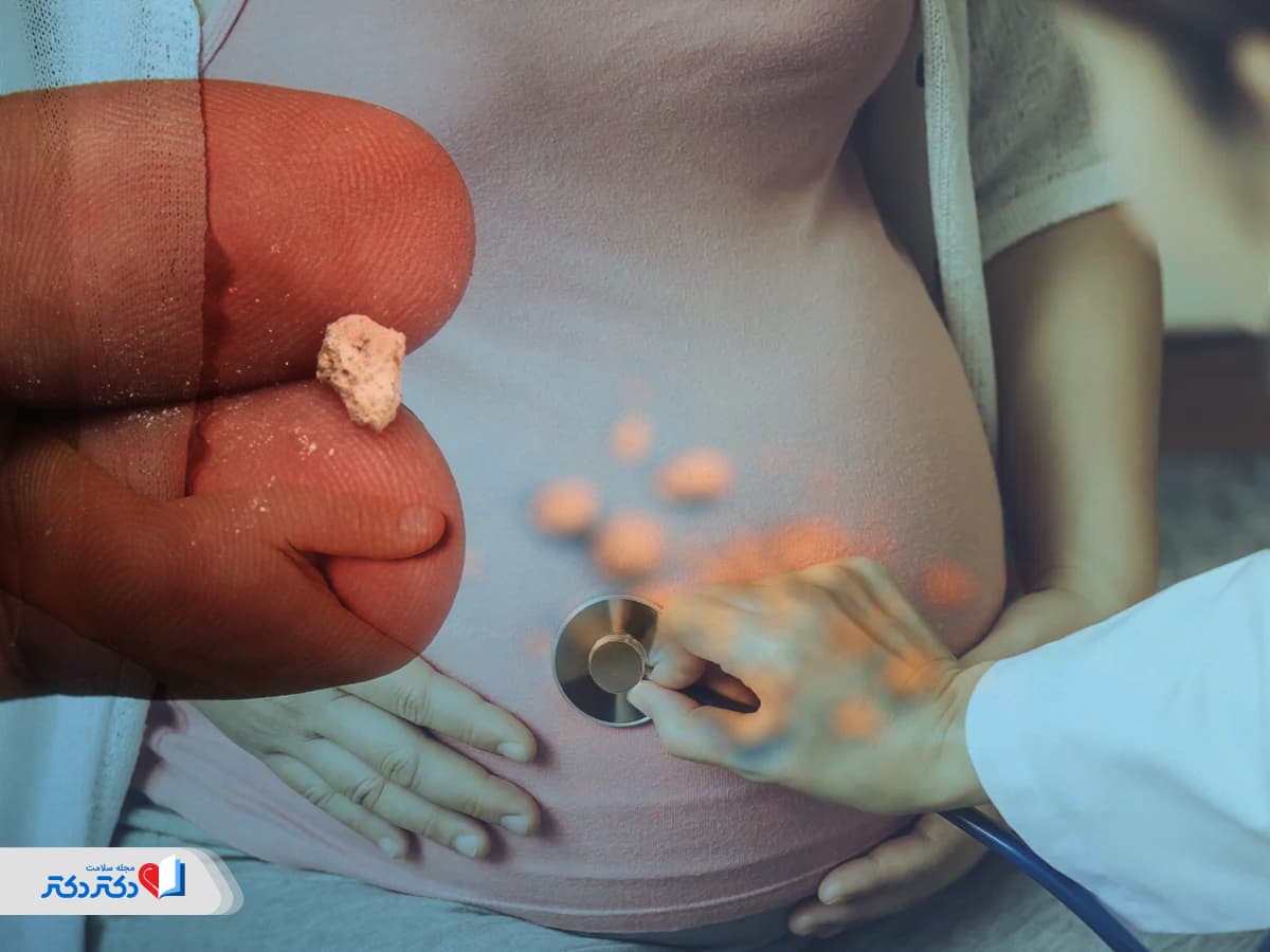 سنگ کلیه در بارداری؛ چگونه بدون آسیب به جنین درد را کنترل کنیم؟