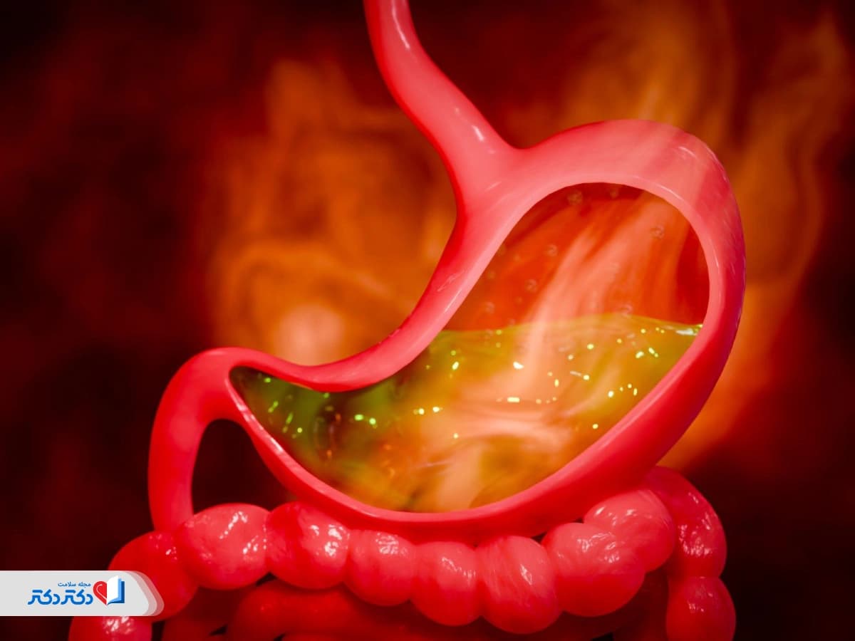 کاهش اسید معده: راهکارهای فوری، رژیم غذایی و درمان خانگی رفلاکس معده در بارداری