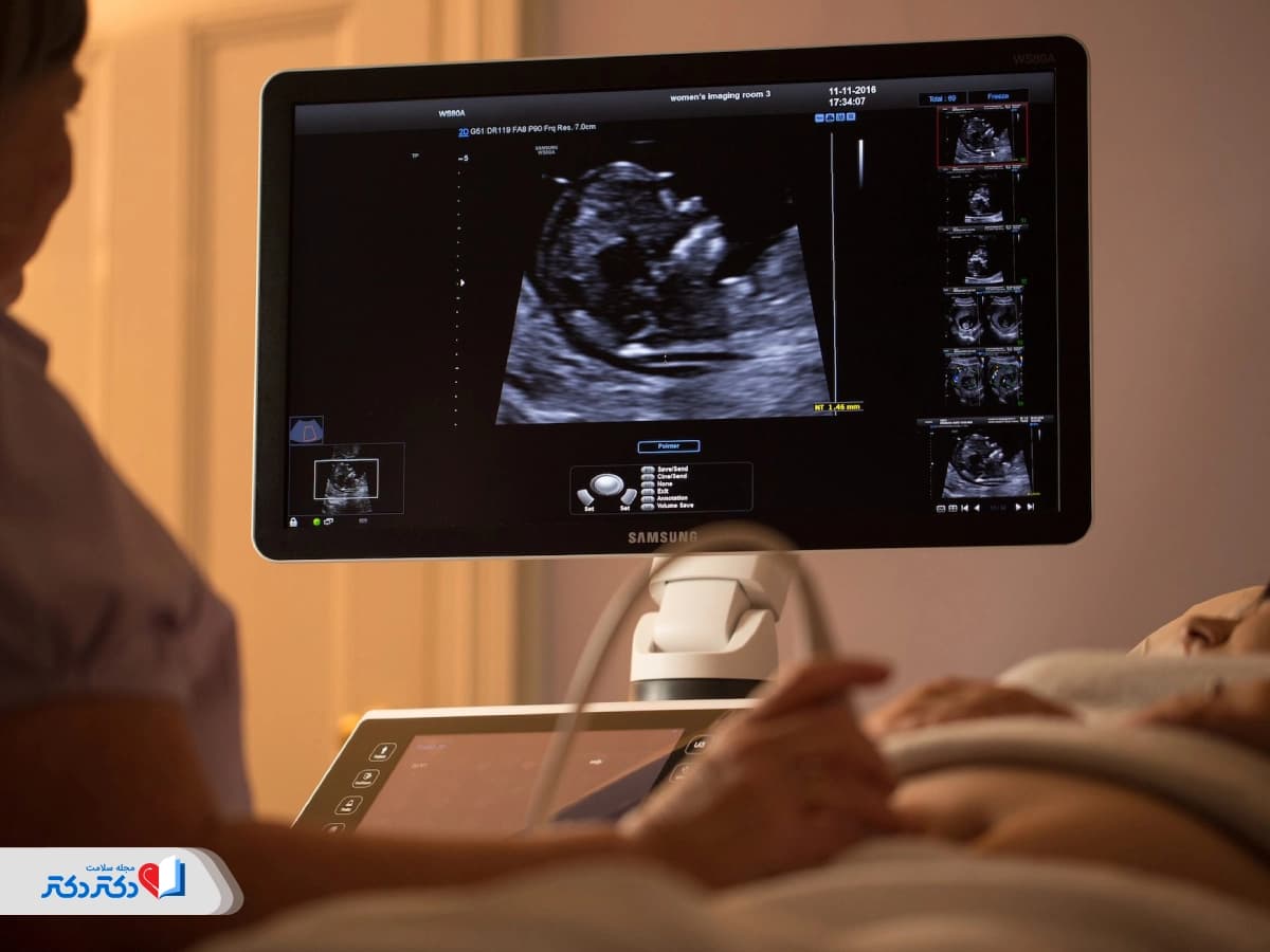 سونوگرافی NT در بارداری چیست و چه اطلاعاتی می‌دهد؟