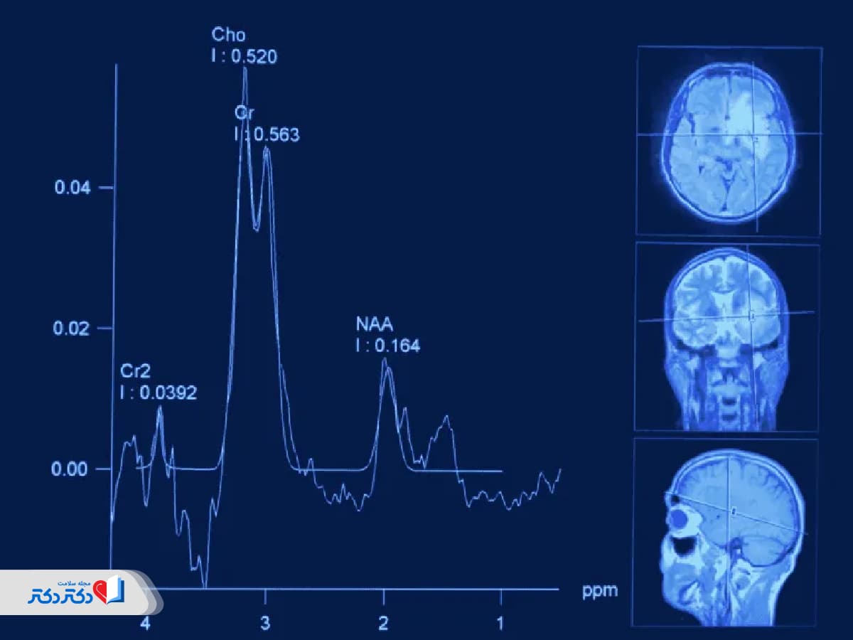 ام آر اس مغز چیست و چه تفاوتی با MRI معمولی دارد؟