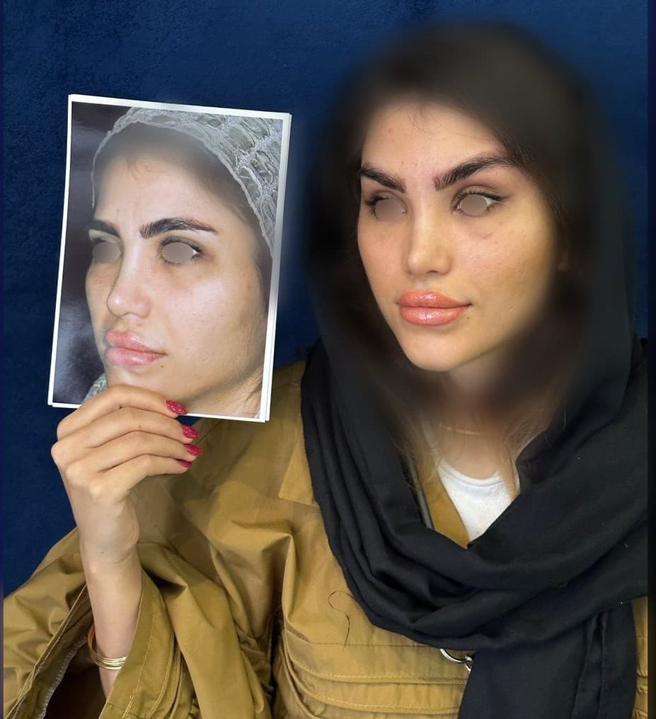 alt قبل و بعد