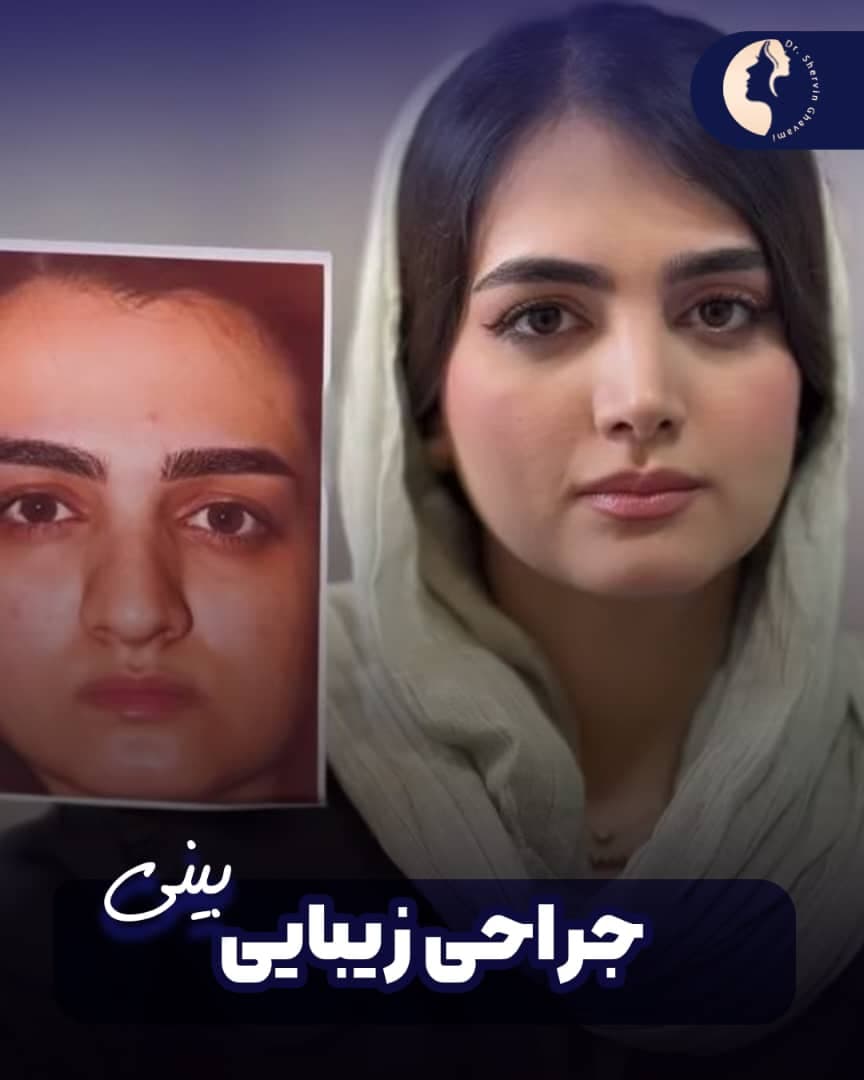 alt جراحی زیبایی بینی