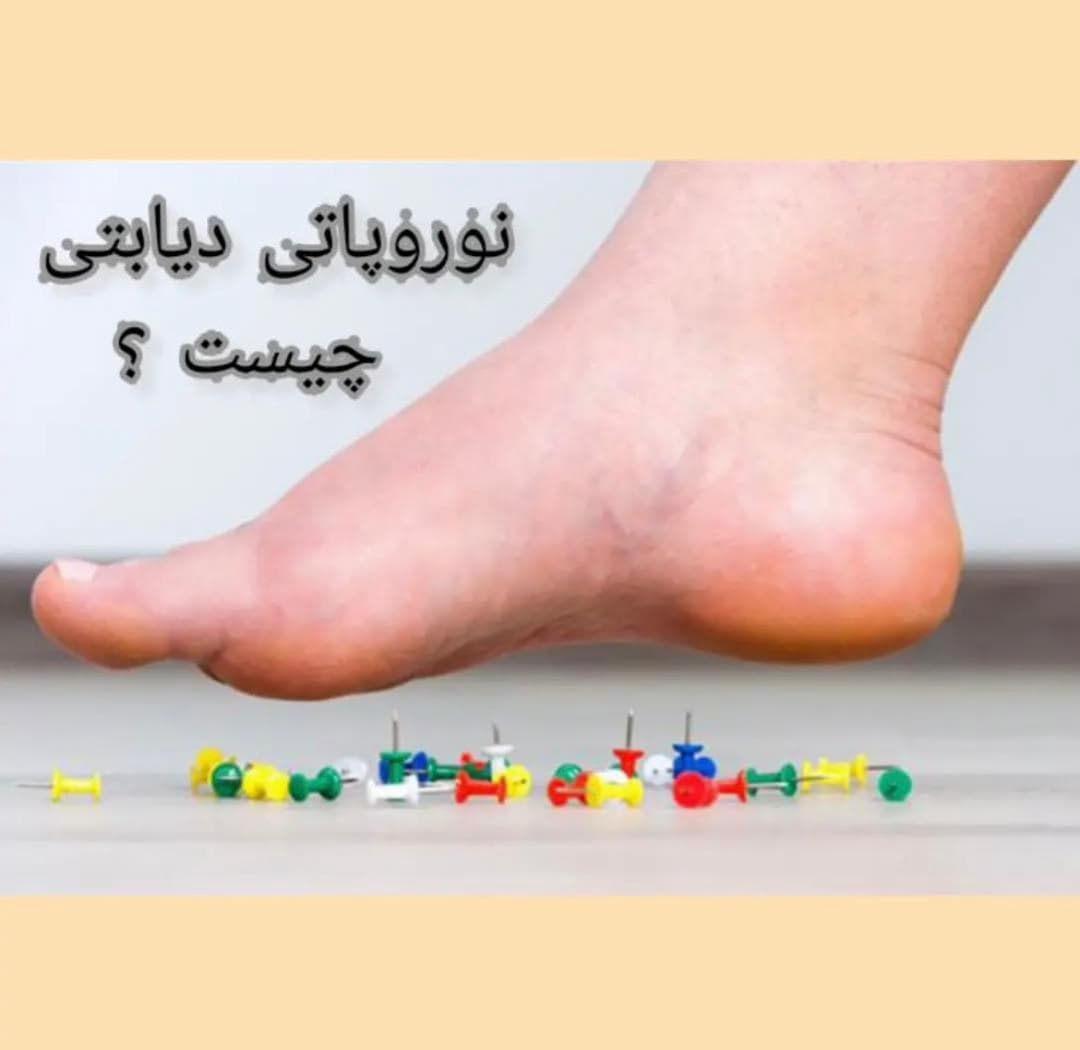 alt نوروپاتی دیابتی