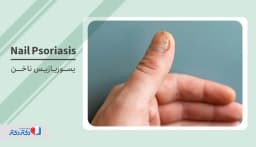پسوریازیس ناخن چگونه تشخیص داده میشود و آیا درمان دارد؟