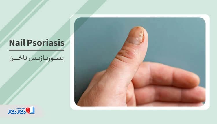 پسوریازیس ناخن چگونه تشخیص داده میشود و آیا درمان دارد؟