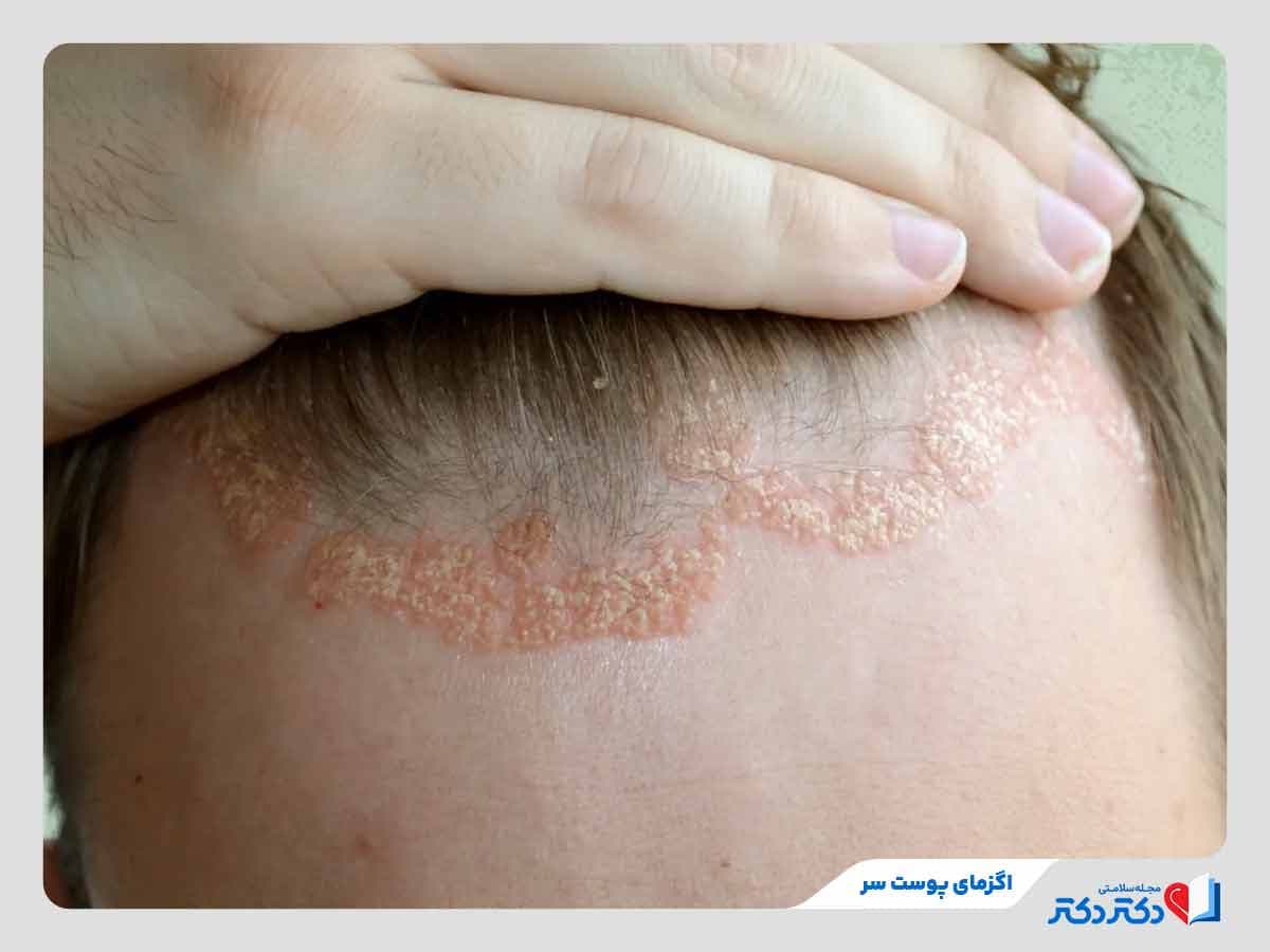 اگزمای پوست سر؛ علل، نشانهها و بهترین راهکارهای کنترل بیماری