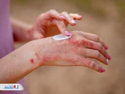 پمادهای موثر برای اگزمای پوستی: راهنمای انتخاب و قیمت