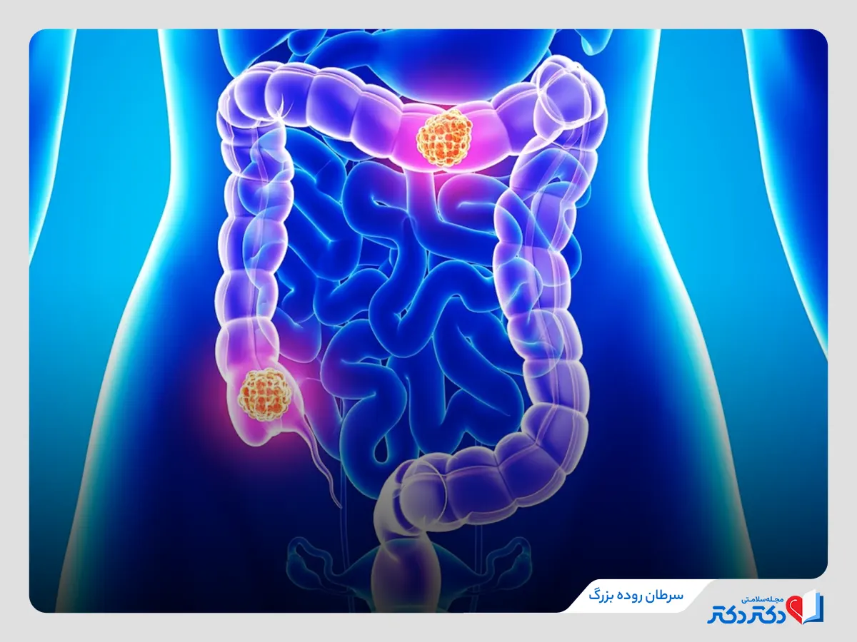 درد زیر شکم در مردان بدلیل سرطان روده بزرگ