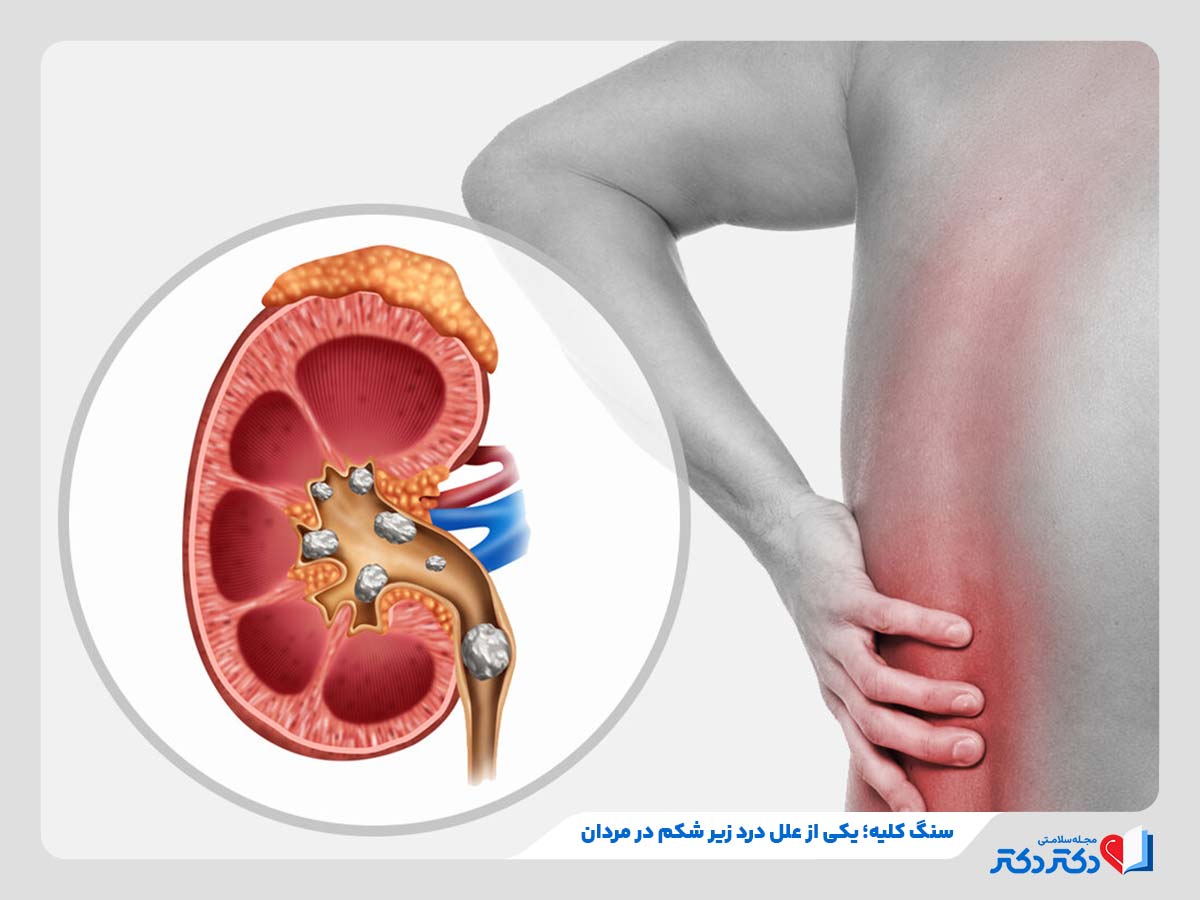 مرد مبتلا به درد زیر شکم به علت داشتن سنگ کلیه