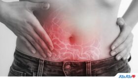 علت نفخ شکم چیست؟ پیشگیری و روش‌های درمان غذایی و دارویی