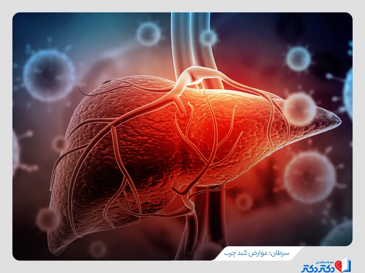 تصویری از کبد با نشانه سرطان از عوارض کبد چرب