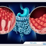 بیماری سلیاک چیست؟ علائم و روش‌های تشخیص و درمان آن