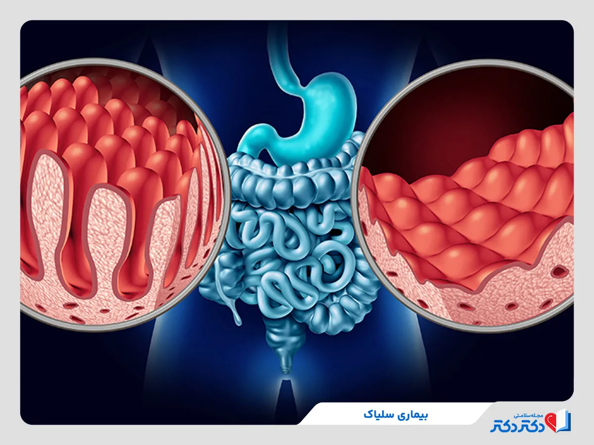 بیماری سلیاک چیست علت و روش های تشخیص