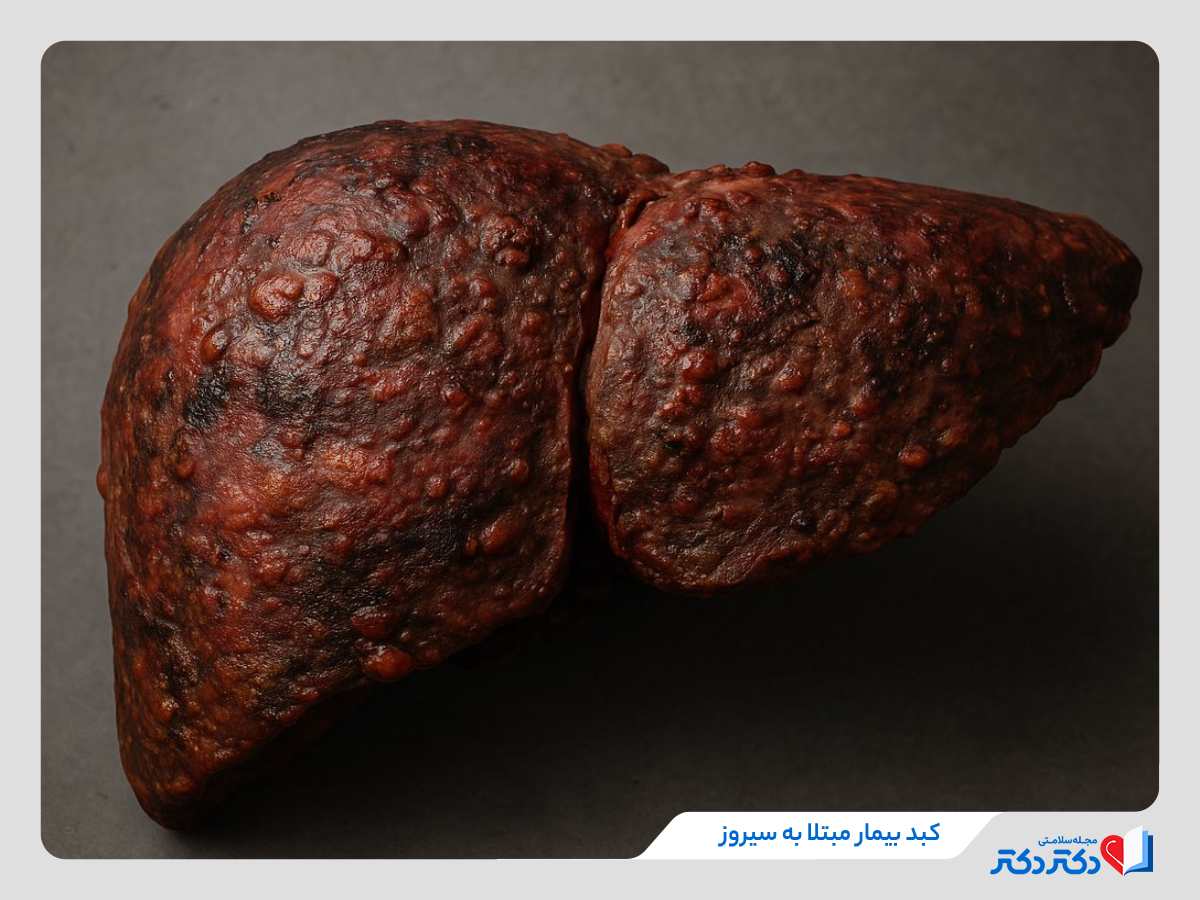 کبد مبتلا به سیروز، عکس سیروز کبدی