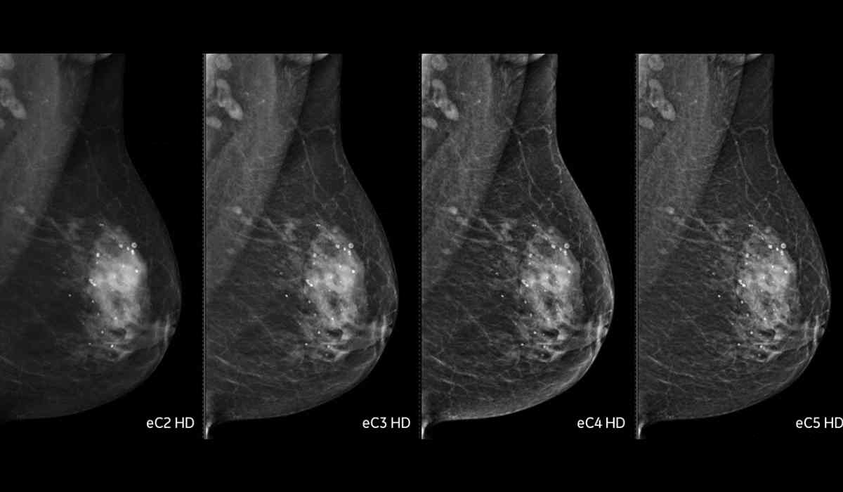 آزمایش ماموگرافی