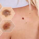 انواع سرطان پوست؛ انواع و نحوه تشخیص و درمان آن