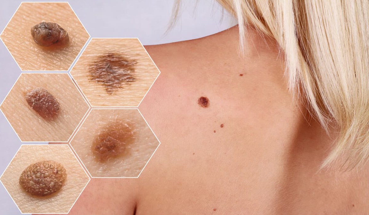 عکس از انواع علائم ظاهری سرطان پوست
