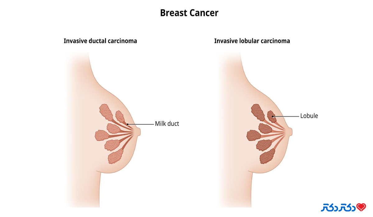 تغییراتی که سرطان سینه ایجاد می کند