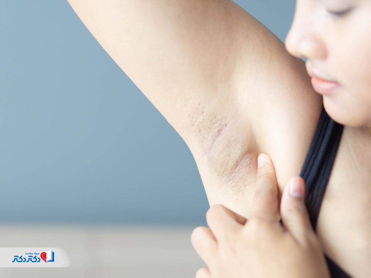 غدد لنفاوی زیربغلی