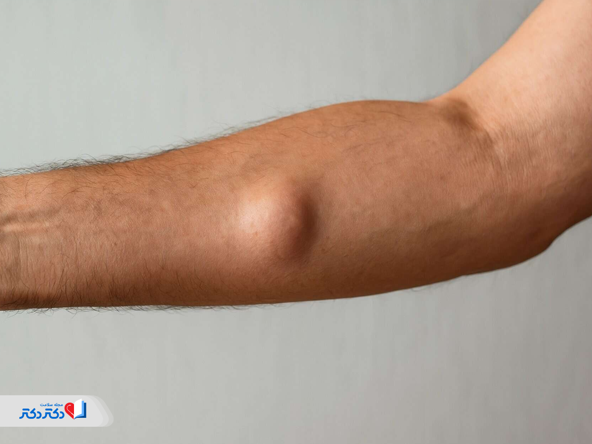 غدد لنفاوی پشت آرنج