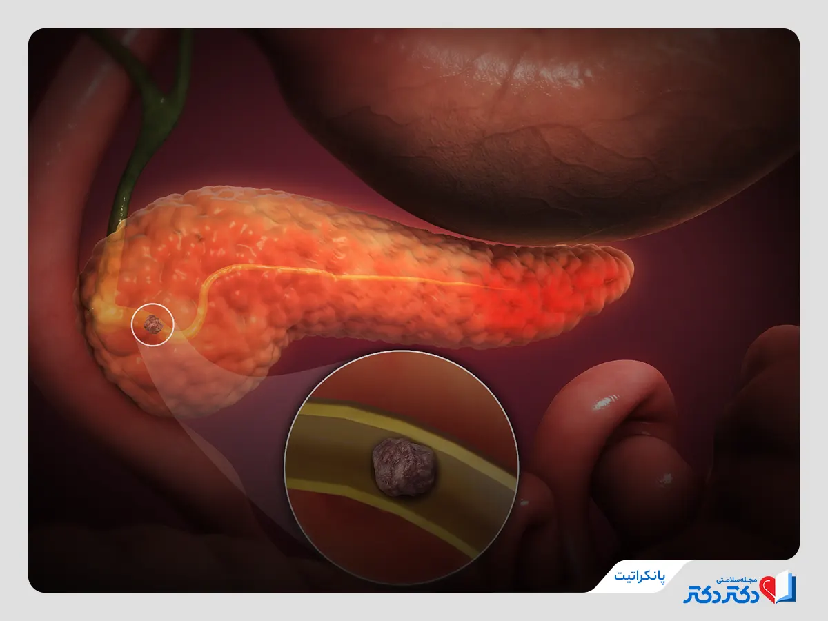 تصویر نشان دهنده پانکراس درگیر بیماری پانکراتیت