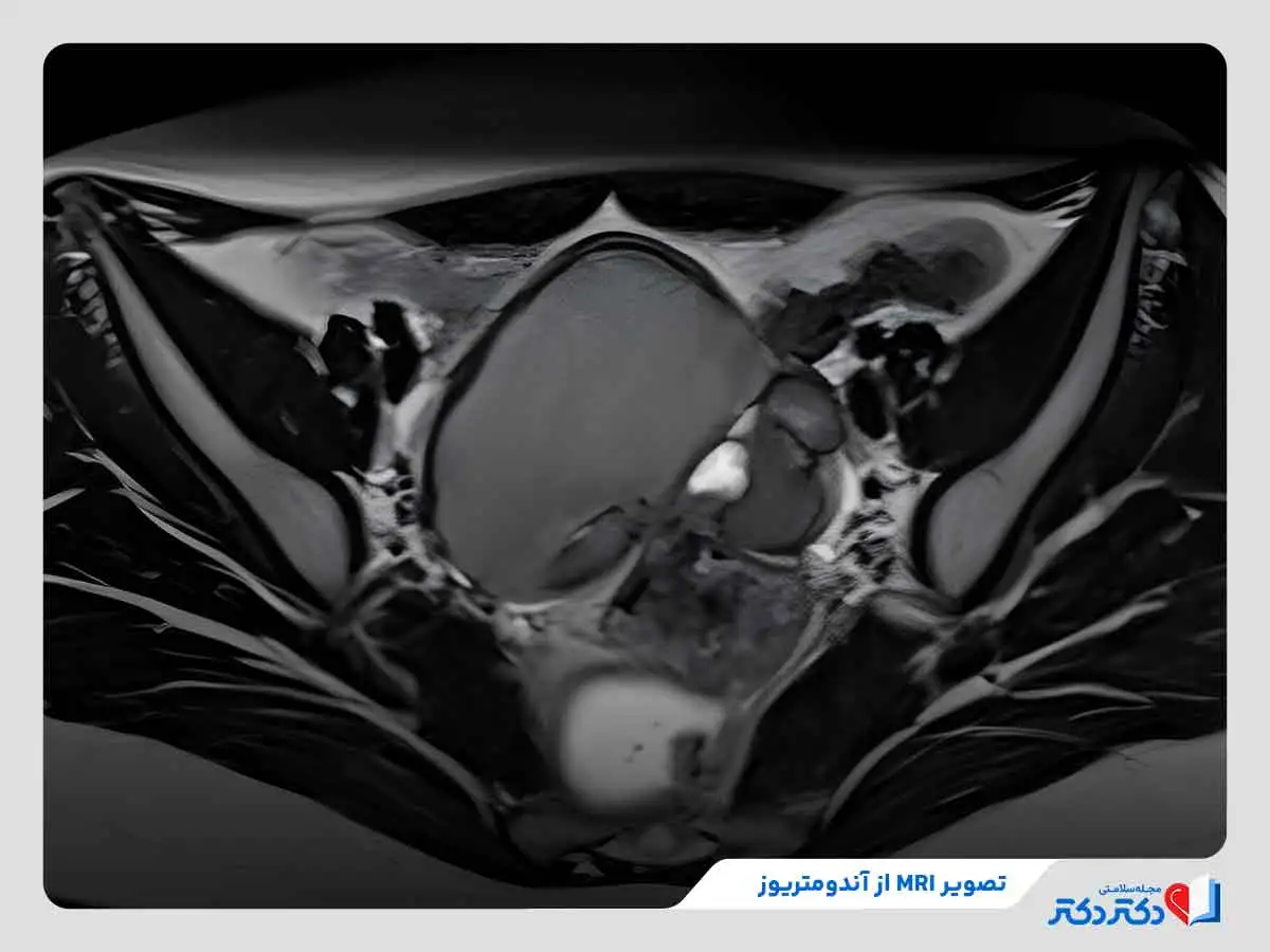 ام آر آی برای تشخیص آندومتریوز
