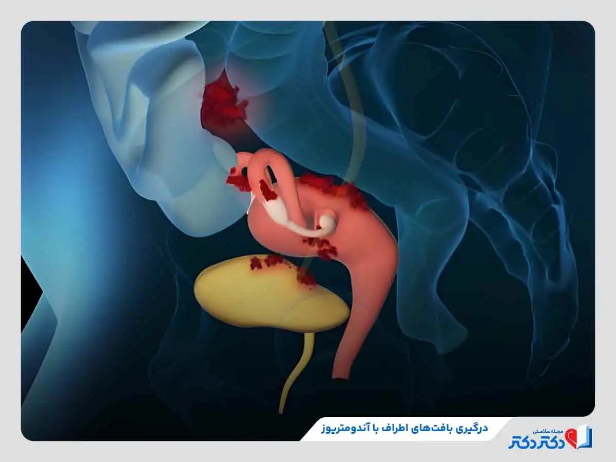 مراحل پیشرفت آندومتریوز