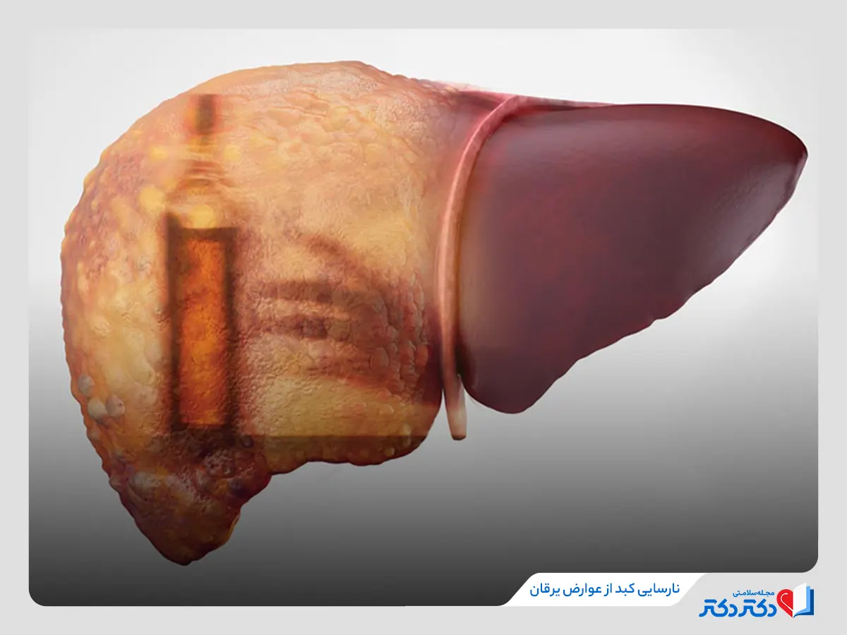 بروز یرقان علت ایحاد نارسایی در کبد 