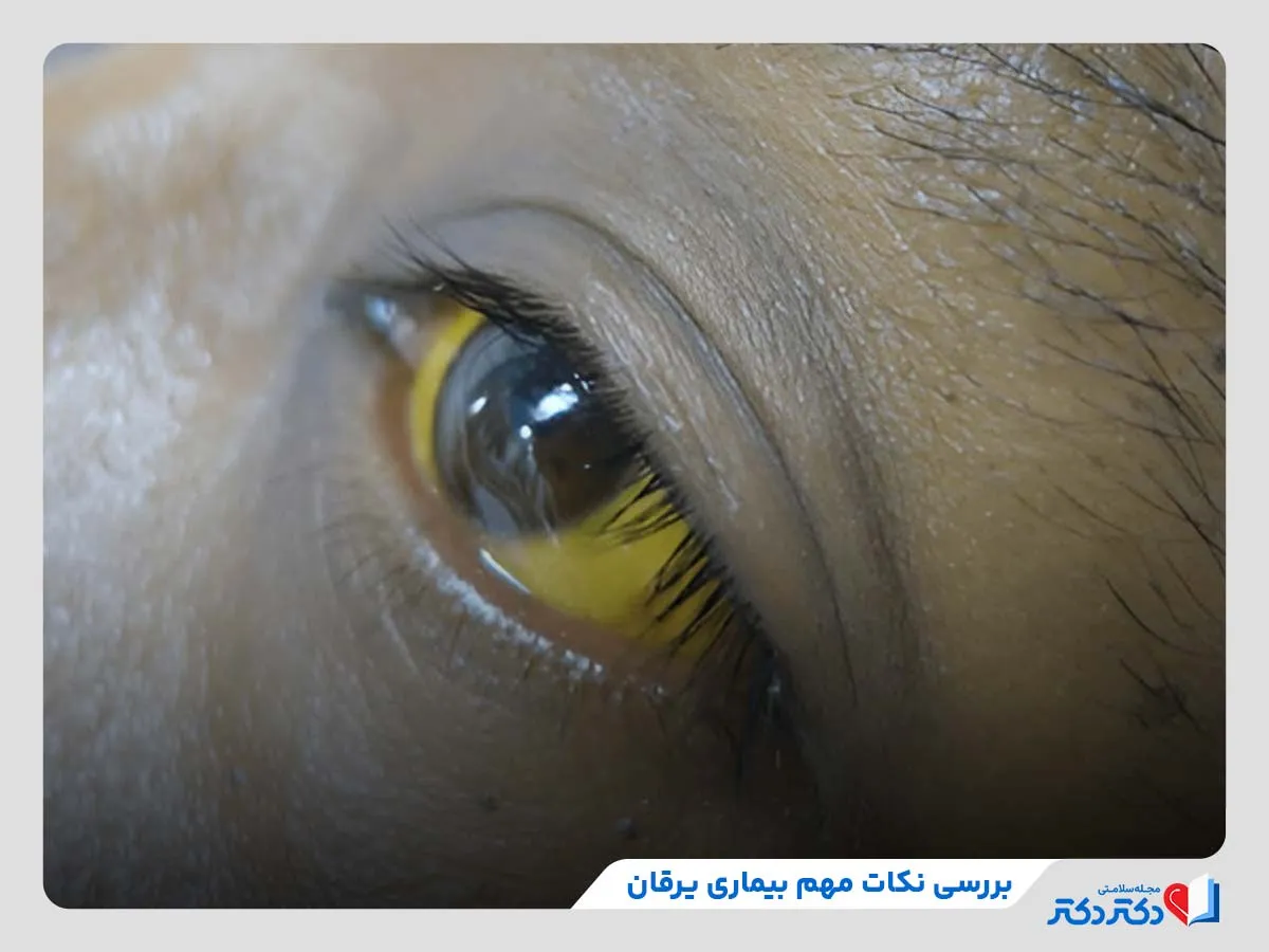 بررسی نکات مهم بیماری یرقان