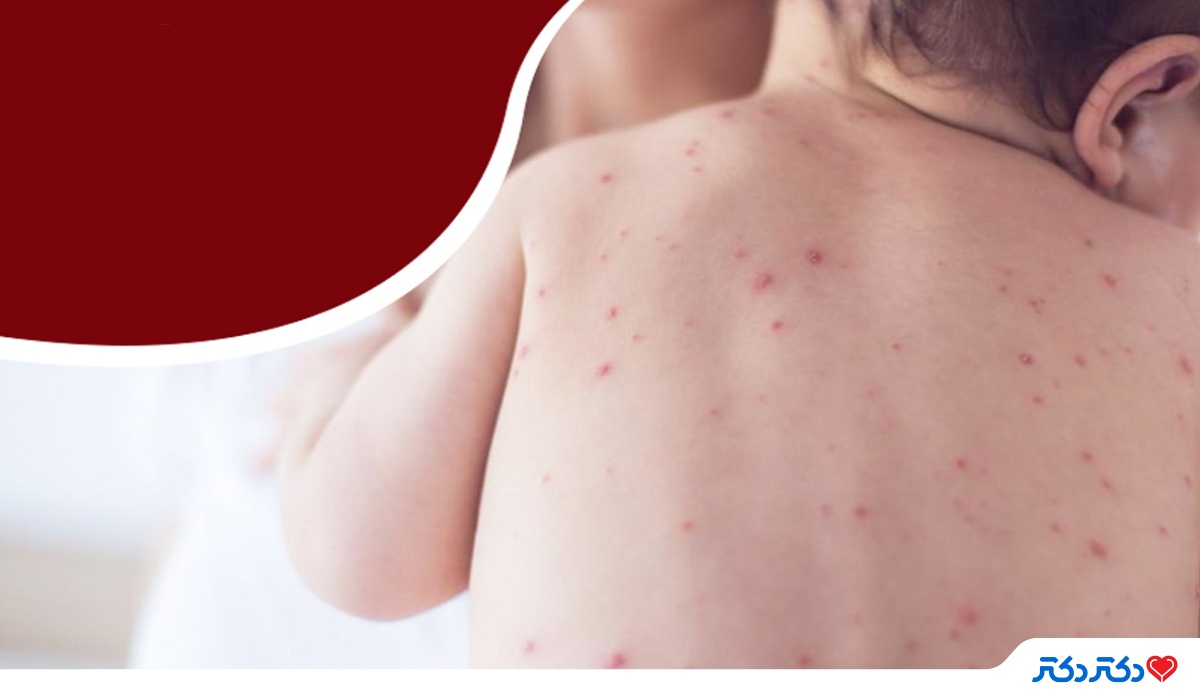 سرخجه؛ بیماری ویروسی در کودکان با علائم پوستی