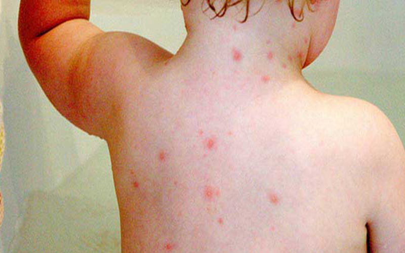 آبله مرغان بیماری شایع ویروسی کودکان با نشانه‌های پوستی | دکتردکتر