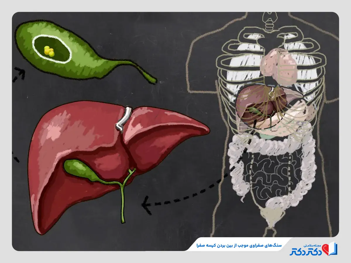 سنگ های صفراوی و از بین رفتن کیسه صفرا