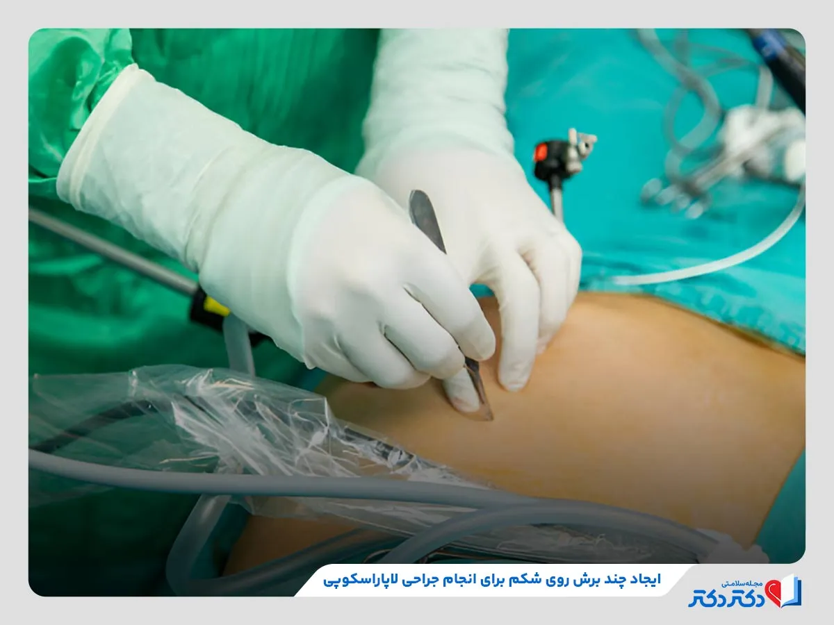 مراحل انجام جراحی لاپاراسکوپی مانند ایجاد برش روی سطح شکم
