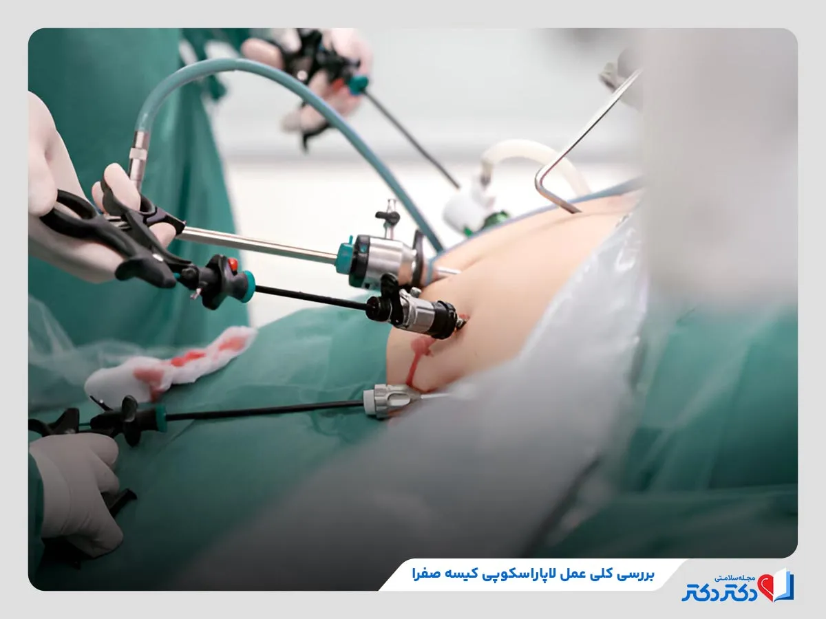 انجام جراحی لاپاراسکوپی برای برداشتن کیسه صفرا